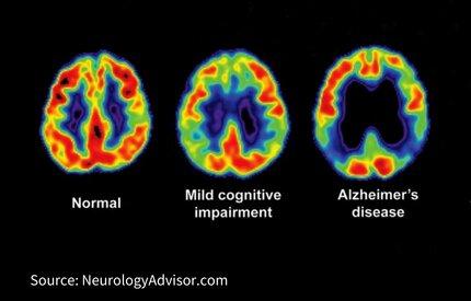 A Machine Learning-Based Early Diagnosis of Alzheimer’s Disease
