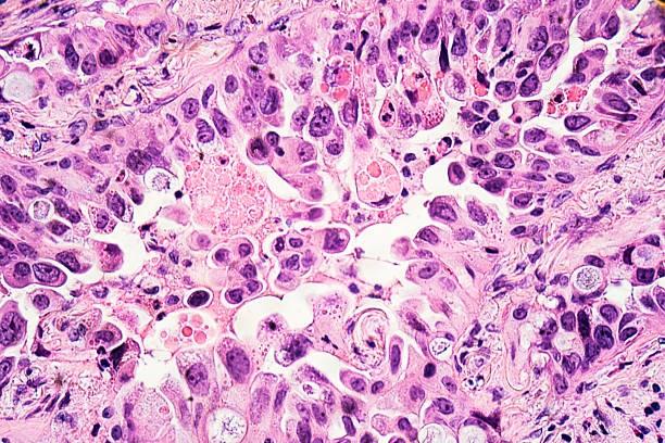 Predicting Melanoma Patient's Responses to Nivolumab Immunotherapy Using Machine Learning Models