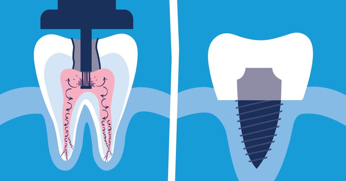 Comparison of Root Canal vs. Dental Implant: Outcome and Success Rates