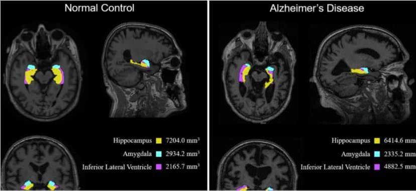 A Machine Learning-Based Early Diagnosis of Alzheimer’s Disease