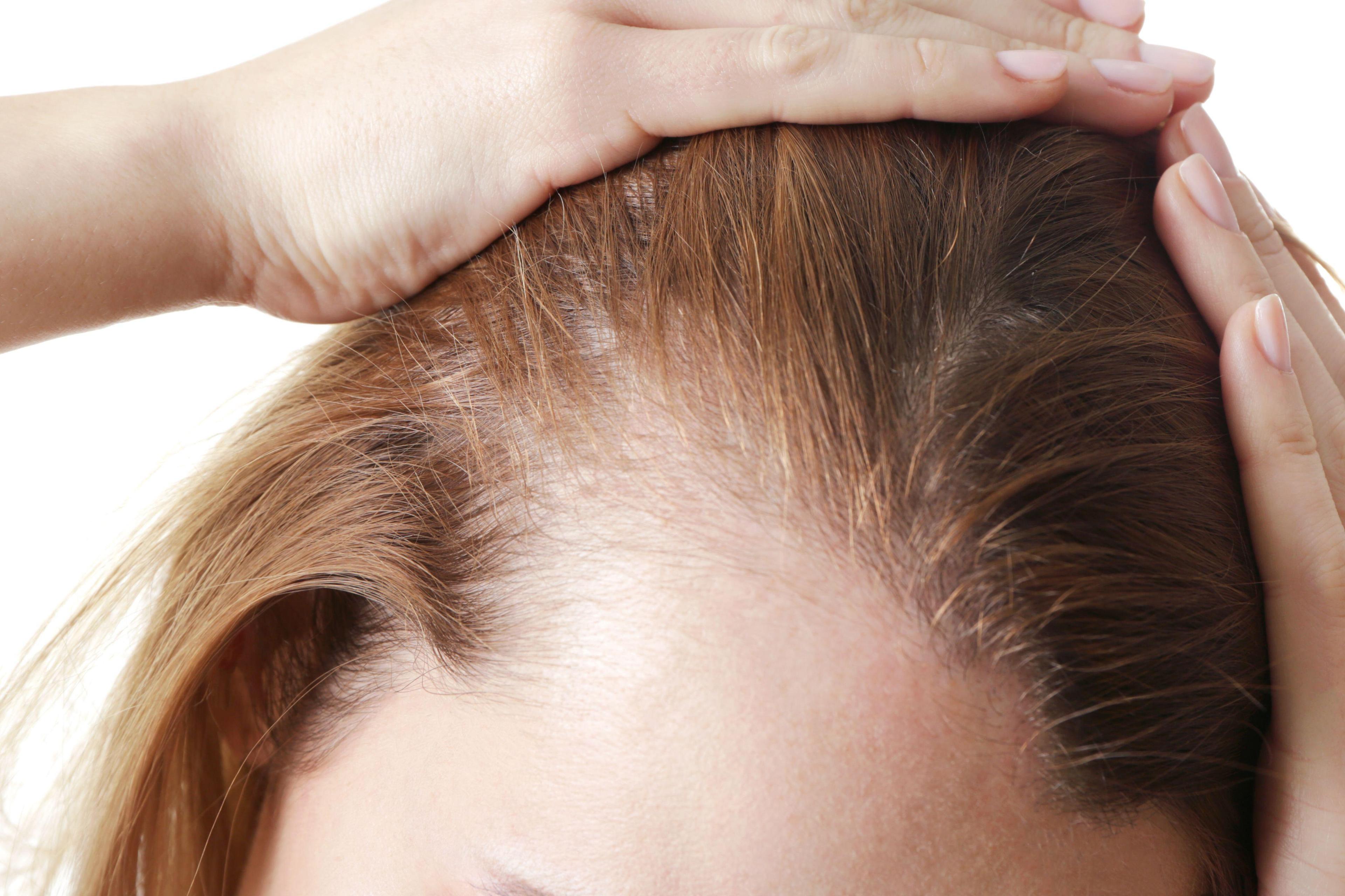 What are the most common types of hair loss and their treatment options?