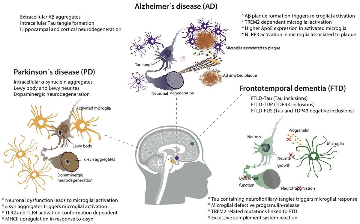 Analyzing the Connections of Microglial Phenotypes in the Progression of Neurodegeneration and Tumors And The Future For Therapeutic Treatments