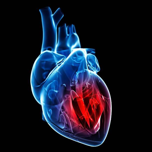 Comprehensive Bioinformatics Meta-Analysis of Coronary Artery Disease and Myocardial Infarction