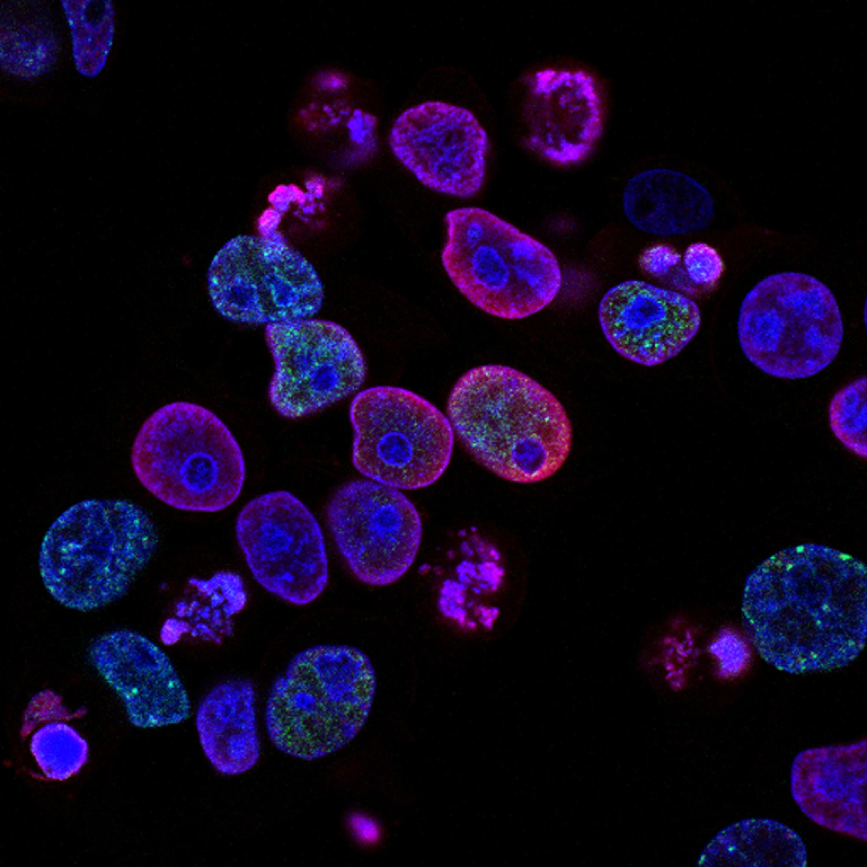 The Role of Epithelial Cell Extrusion in Carcinoma: Mechanotransduction and Drug Treatment