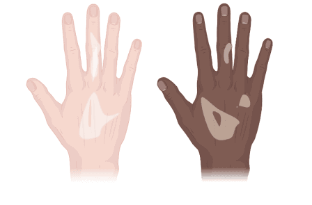 A Review on Vitiligo: Pathogenesis, Etiology, Psychological Impacts, and Treatments.