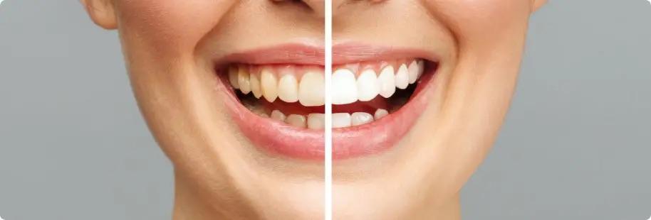 Teeth whitening tools and its effects on teeth and gum health